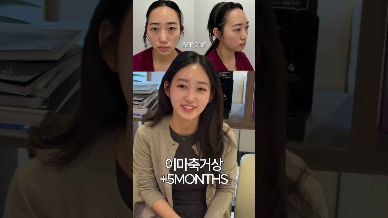 이마축거상 5개월차 경과❤️