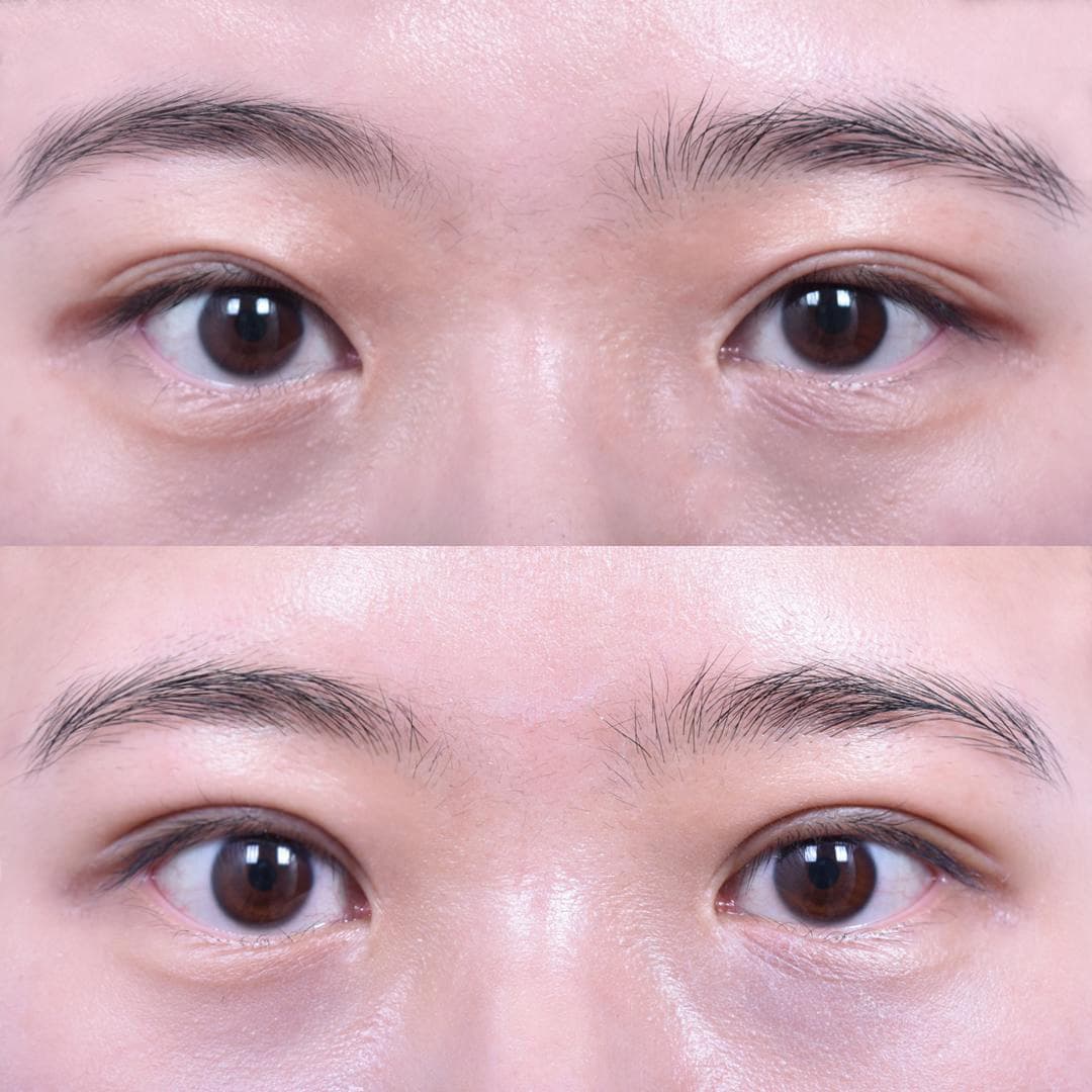 Non-Incisional Eye Lid Correction (After 1 Month)