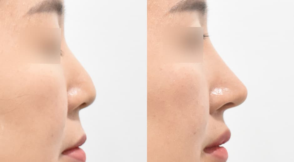Philtrum-Nose · Lip Lift