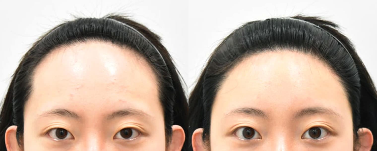 Forehead Reduction
