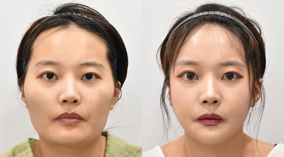 Square Jaw · Revision Facial Contouring · Cheekbone Reduction