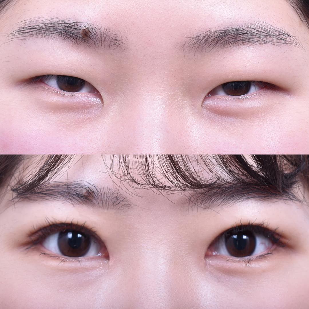 Non-Incisional Eye Lid Correction + Epicanthoplasty (1 Month Post-Op)