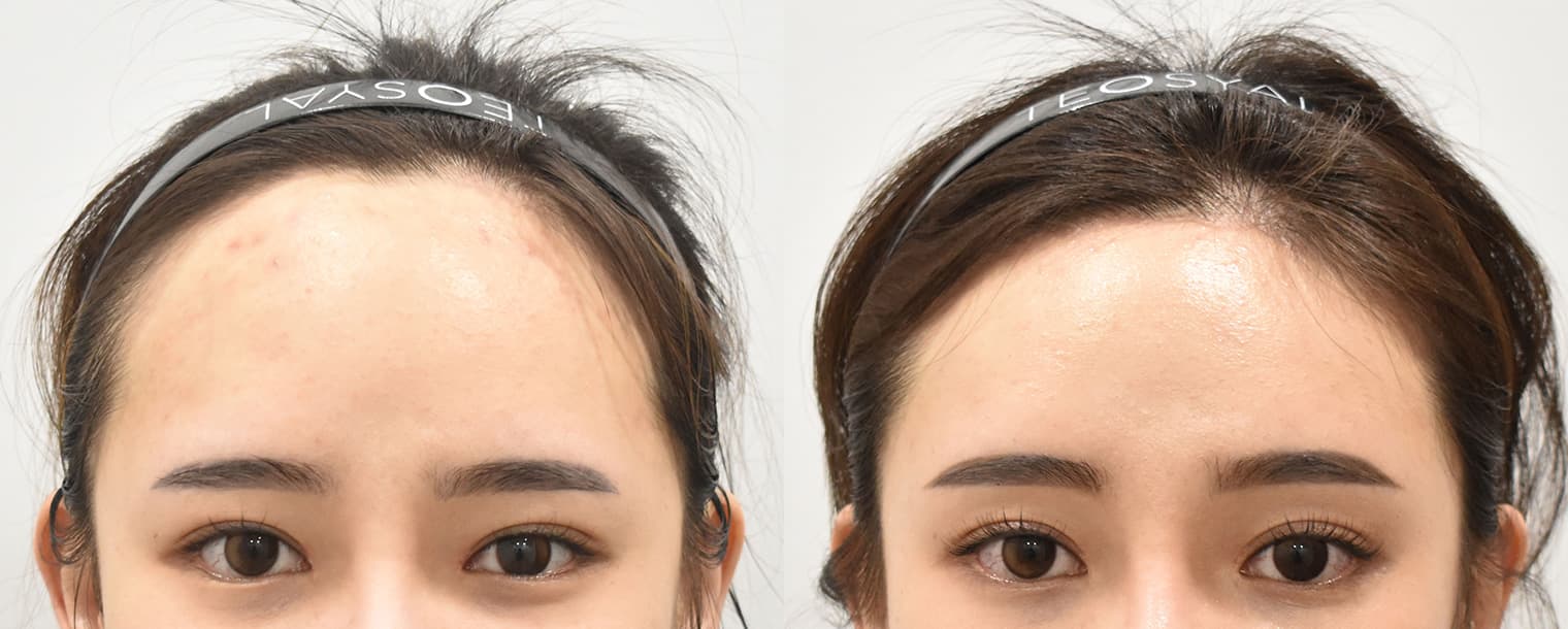 Forehead Reduction · M-shaped Hair Transplant · Forehead Lift