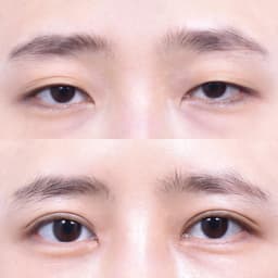 Non-Incisional Eye Lid Correction · Epicanthoplasty · Superior Epicanthoplasty (1 Month Post-Op)