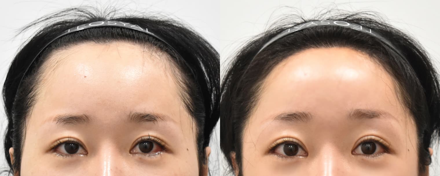 Forehead Reduction
