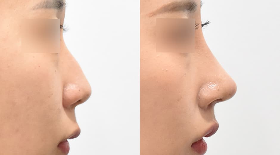 Philtrum-Nose · Lip Lift