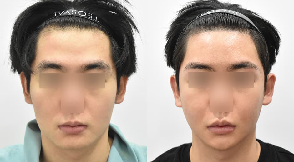 Square Jaw Surgery · Genioplasty