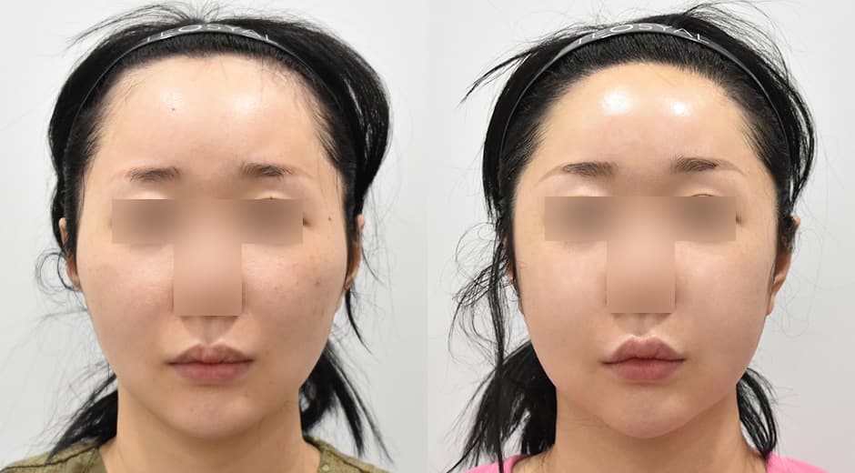 Cheekbone Reduction · Forehead Reduction