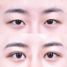 Non-Incisional Eye Lid Correction · Epicanthoplasty · Superior Epicanthoplasty (3 Weeks Post-Op)
