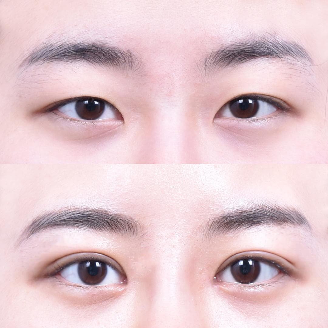 Non-Incisional Eye Lid Correction · Epicanthoplasty · Superior Epicanthoplasty (3 Weeks Post-Op) 1