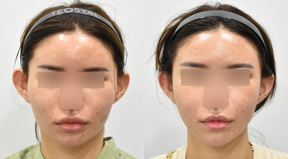 Cheekbone Reduction · Square Jaw Surgery