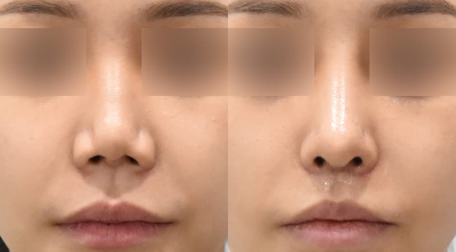 Lip Lift (Revision) · Philtrum-Nose 1