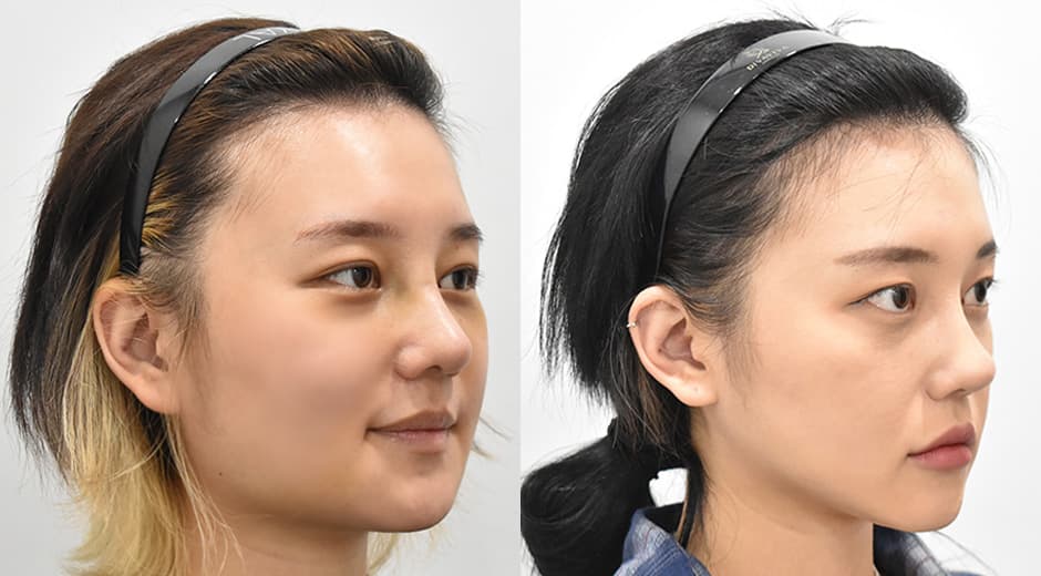 Square Jaw Surgery