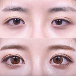 Non-Incisional Eye Lid Correction + Epicanthoplasty + Lateral Epicanthoplasty (3 Months Later)