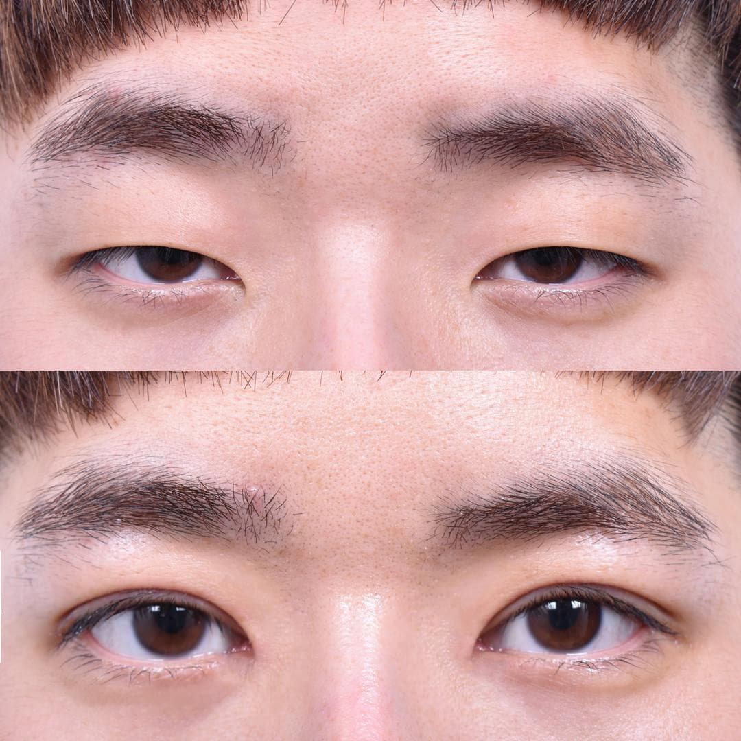 Non-Incisional Eye Lid Correction · Epicanthoplasty (1 Week Post-Op) 1