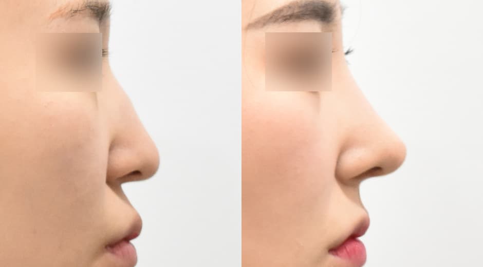 Philtrum - Nose