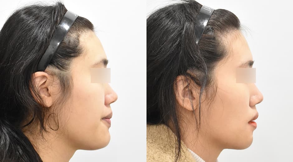 Genioplasty