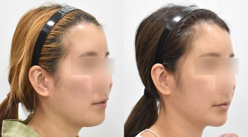 Genioplasty