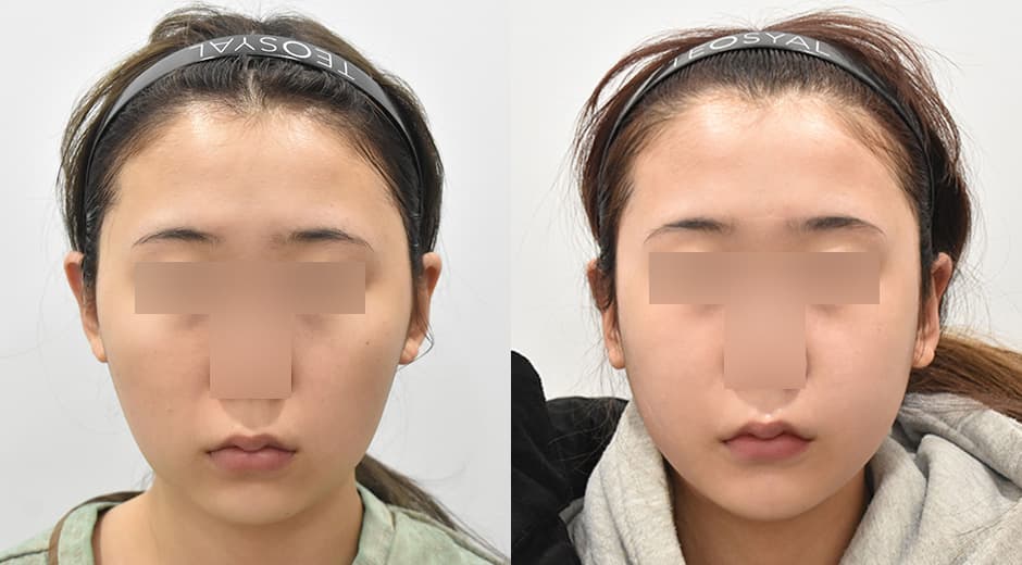 Genioplasty · Cheekbone Reduction