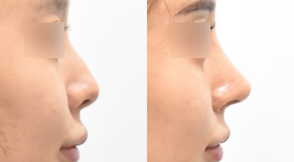 Philtrum - Nose