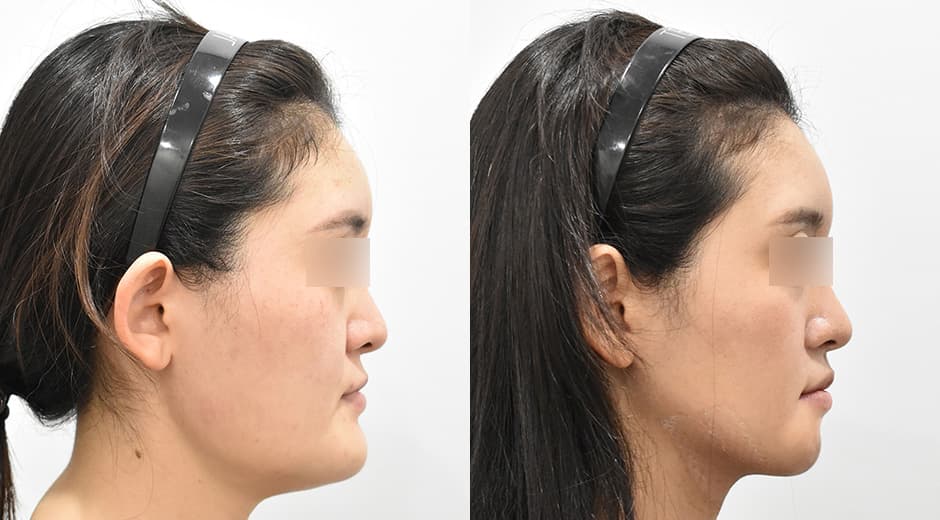 Genioplasty