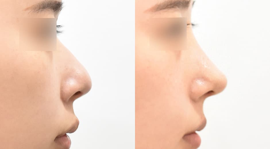 Philtrum - Nose