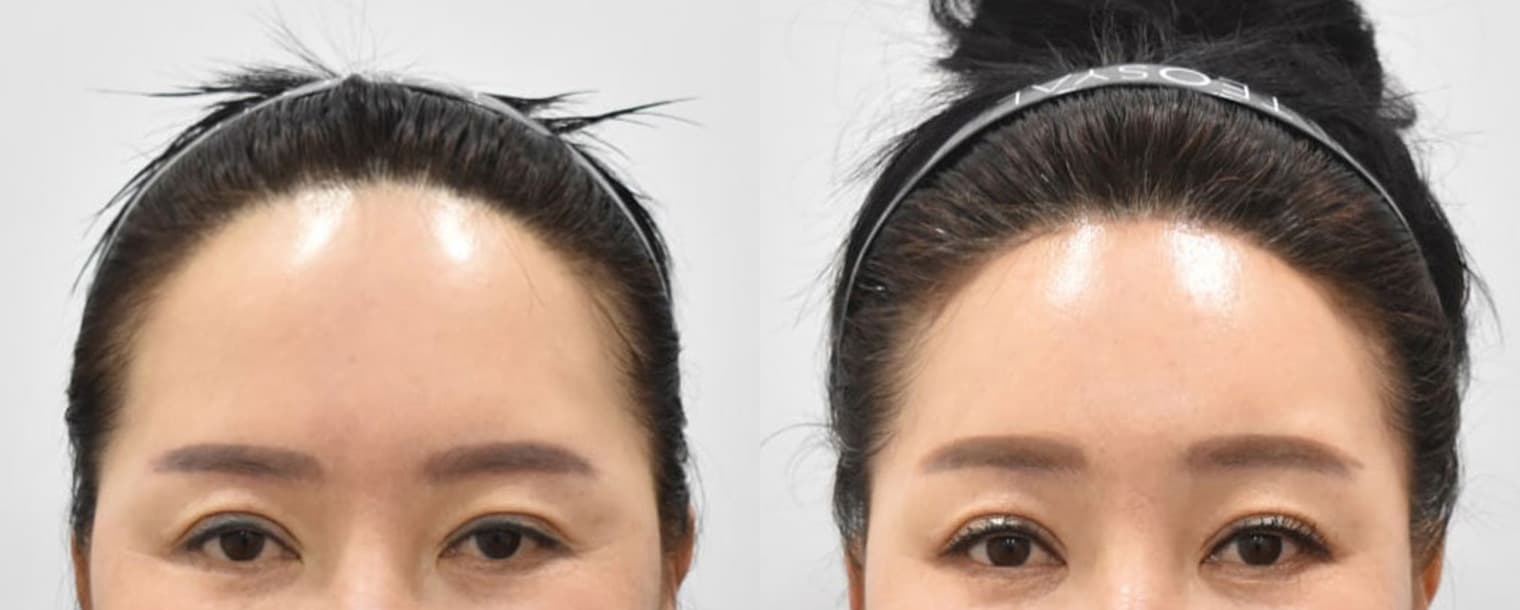 Forehead Reduction · Forehead Lift