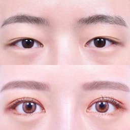 Eye Lid Correction · Sub-Brow Lift · Lateral Canthoplasty · Lower Canthoplasty (1 Month Post-Op)