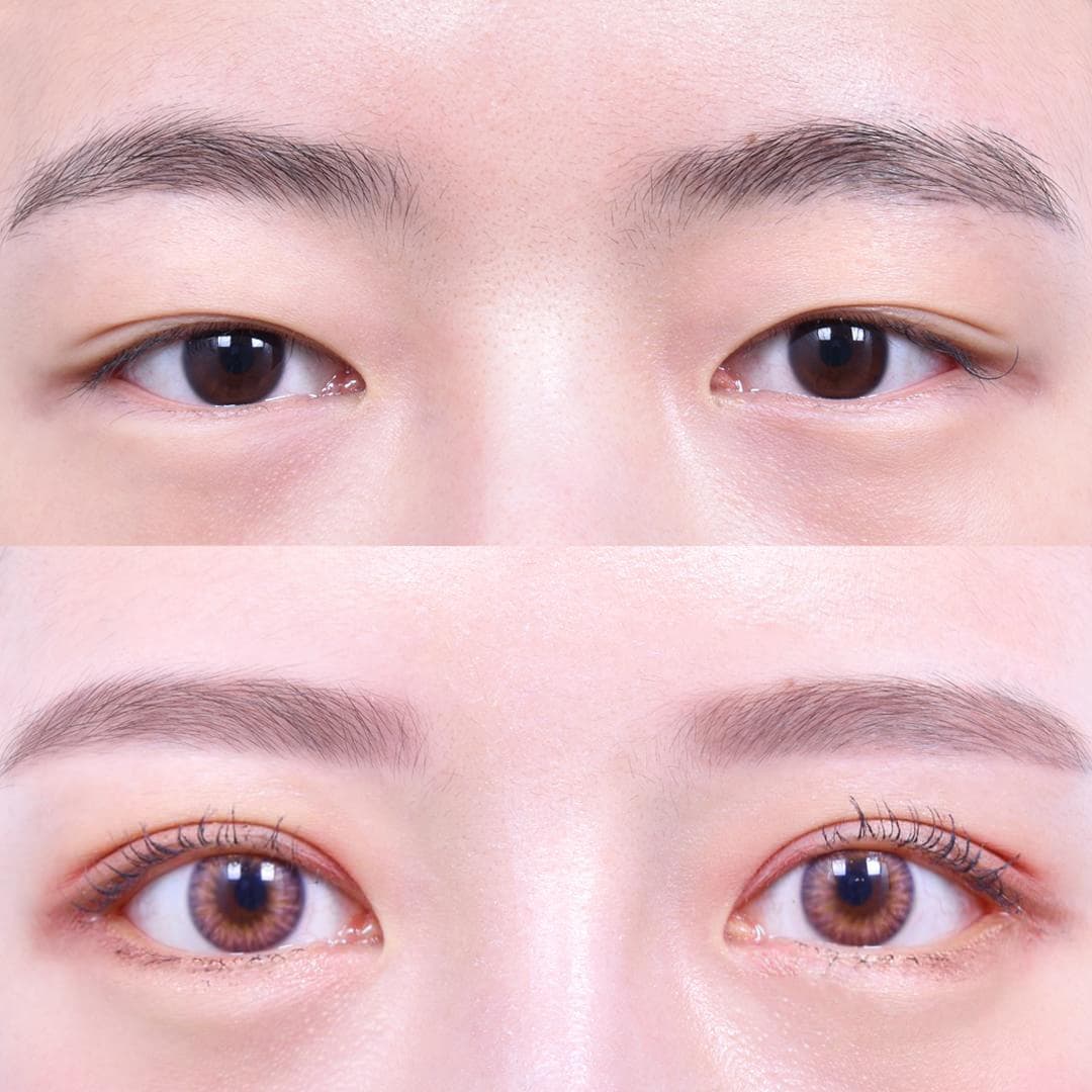 Eye Lid Correction · Sub-Brow Lift · Lateral Canthoplasty · Lower Canthoplasty (1 Month Post-Op) 1