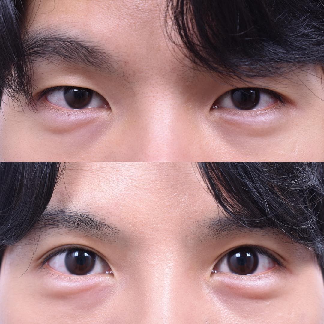 Eye Revision Surgery (3 Weeks Post-Op)