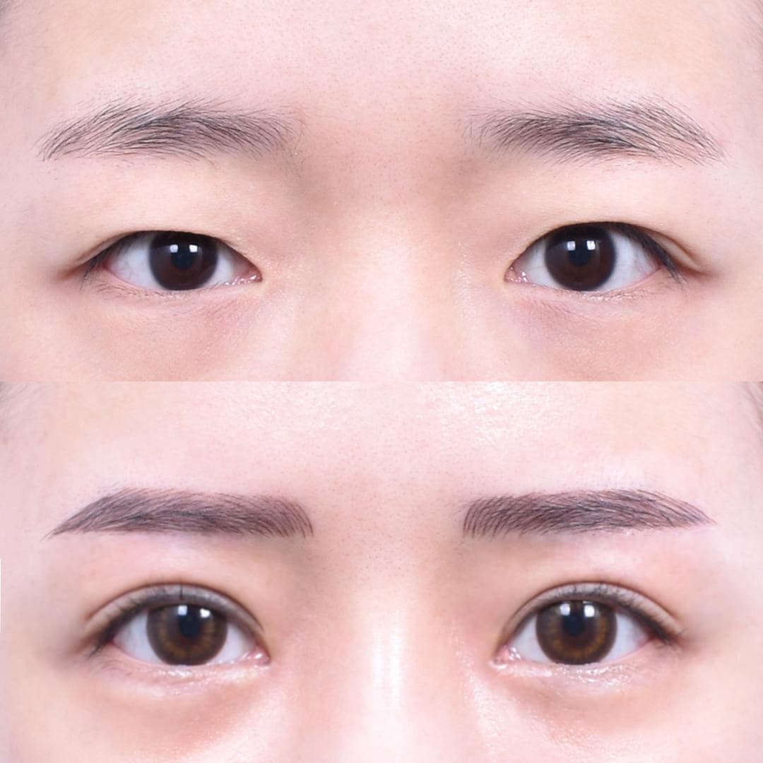 Sub-Brow Lift · Non-Incisional Eye Lid Correction · Lateral Canthoplasty (1 Month Post-Op) 1