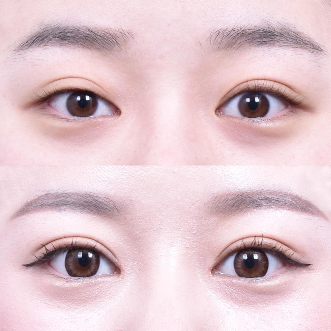 DES + Epicanthoplasty (1 Month Later)