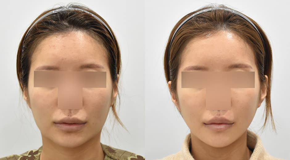 Square Jaw Surgery