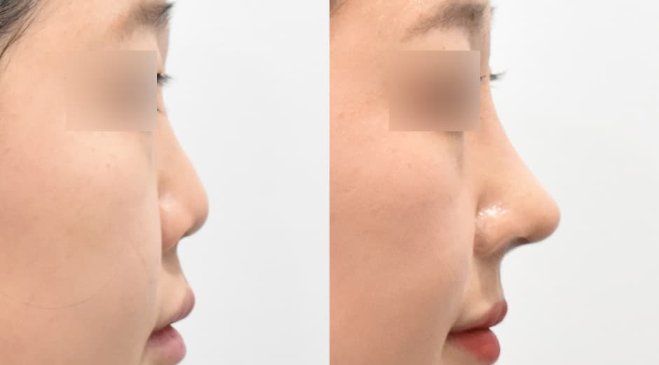 Philtrum - Nose