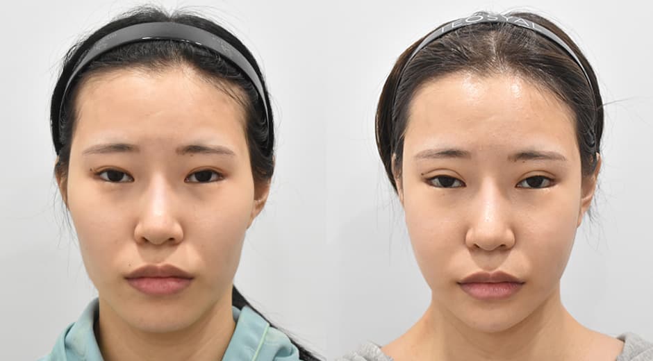 Square Jaw · Revision Facial Contouring · Cheekbone Reduction