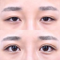Partial Incision Eyelid Correction (After 1 Month)