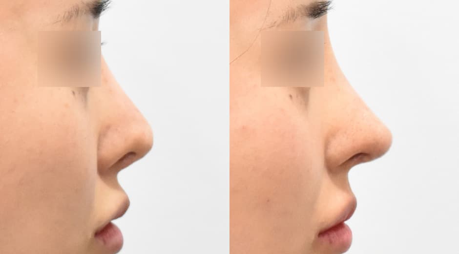 Philtrum - Nose (Revision)