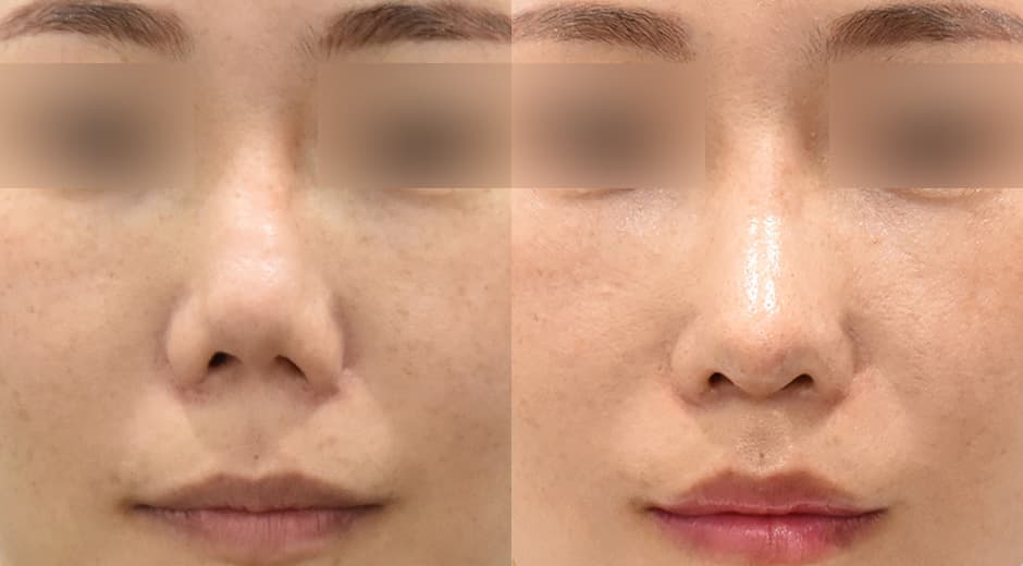 Lip Lift (Revision) · Philtrum-Nose