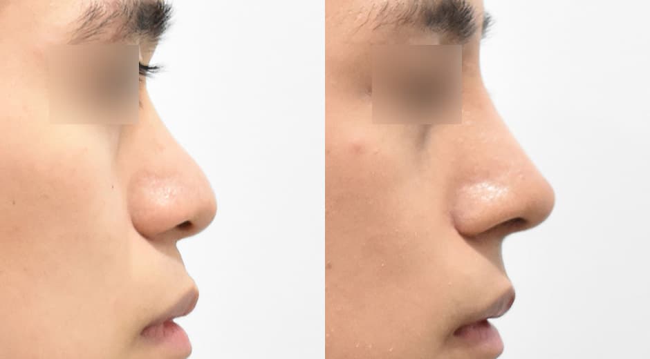 Philtrum - Nose