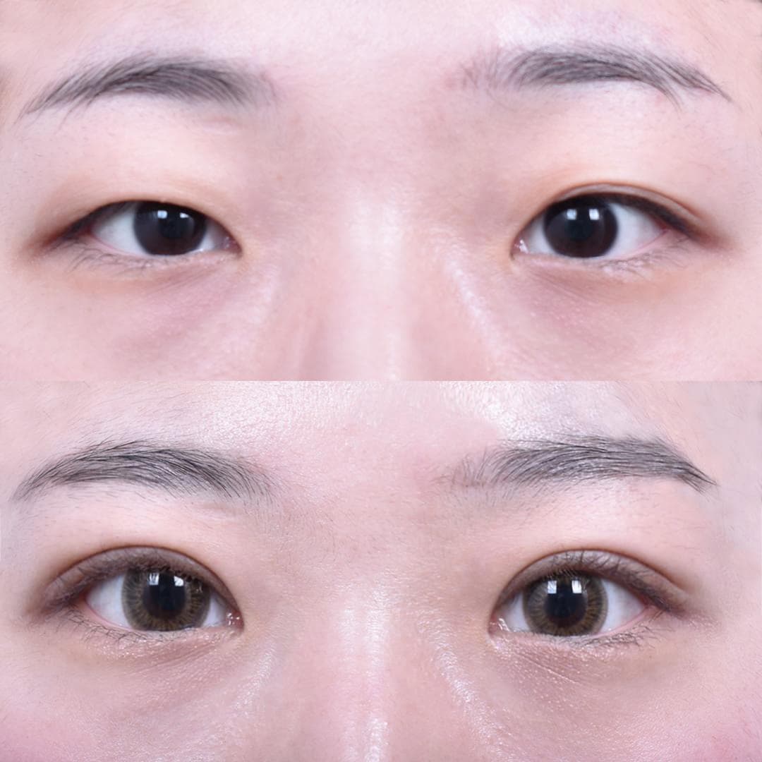 Non-Incisional Eye Lid Correction + Epicanthoplasty (1 Month Post-Op)