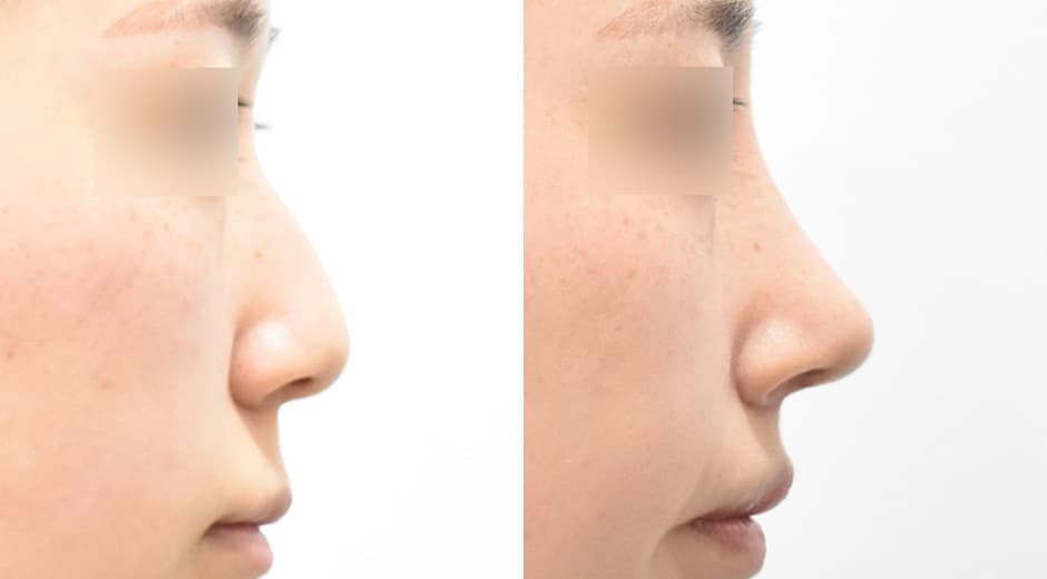 Philtrum-Nose · Lip Lift