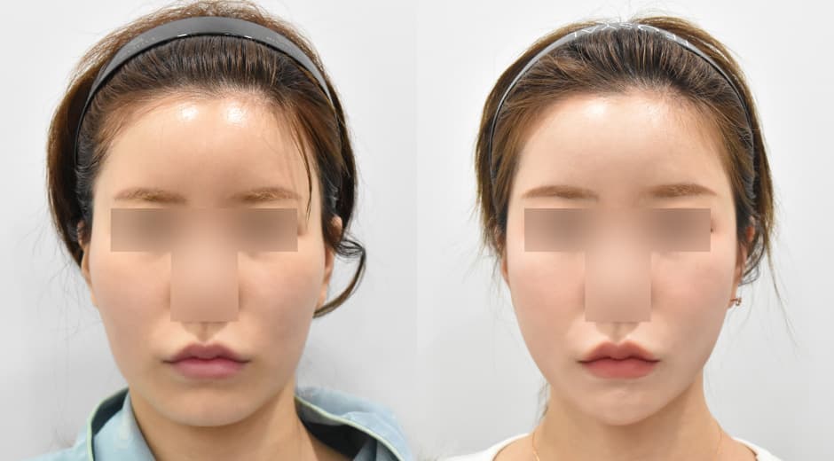 Cheekbone Reduction · Square Jaw Surgery · Genioplasty