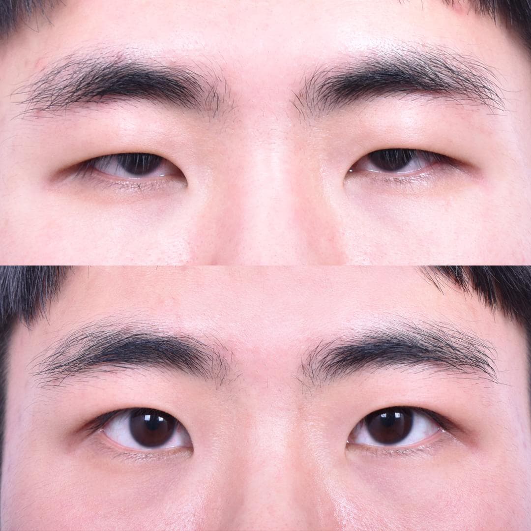 Non-Incisional Eye Lid Correction (After 1 Month)