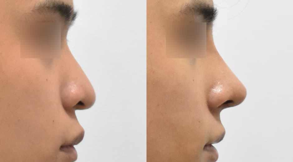 Philtrum - Nose